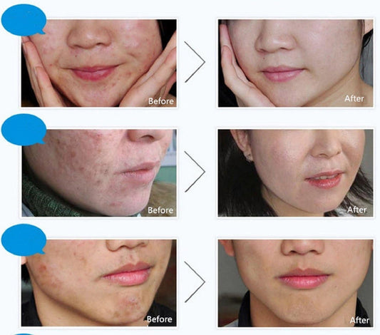 BIOAQUA Herbal Anti-Acne Cream 30g Saudi Arabia